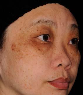 Evaluation of other features Sebaceous pores Ocular pigmentation Cheek sebaceous pores Ocular area