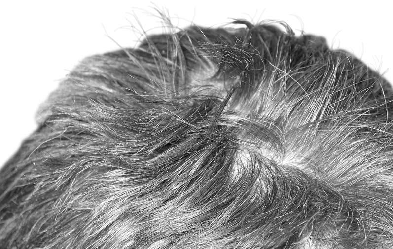 How to treat head lice u You should only ever treat someone for head lice if you have found a living, moving louse. u The best treatment is to use lotion* (not shampoo and mousses) from the chemist.