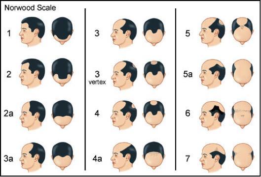 SCALP MICROPIGMENTATION Norwood scale for men Slightly receding hairline. a : strong frontal recession. Receding hairline moves towards the top of the head.