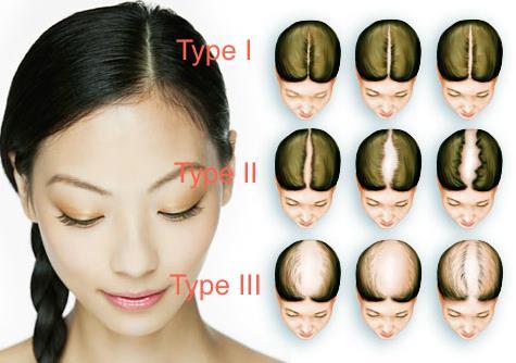 SCALP MICROPIGMENTATION Ludwig scale for women TYPE Ι : miniaturization of hair results in thinning in the parting region. Hair loss can be hidden.