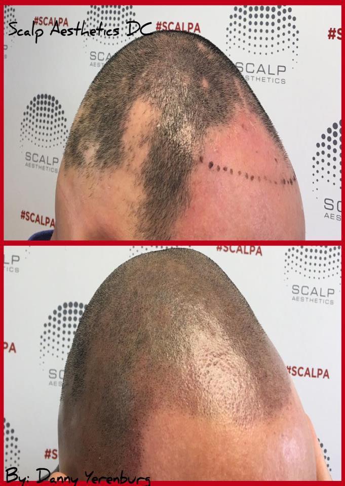 Androgenic alopecia is caused by a change in androgens, and it typically occurs in men who are over 50 years old.