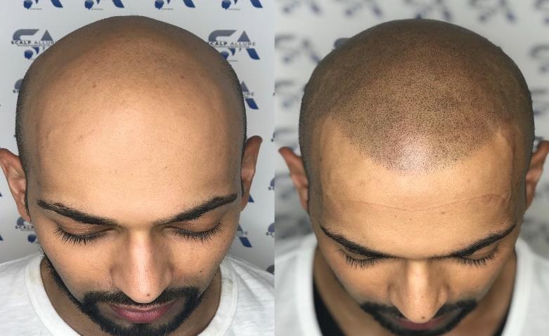 deformities on the scalp Patients with linear, FUE, FUT scars: post surgical scars on the scalp,