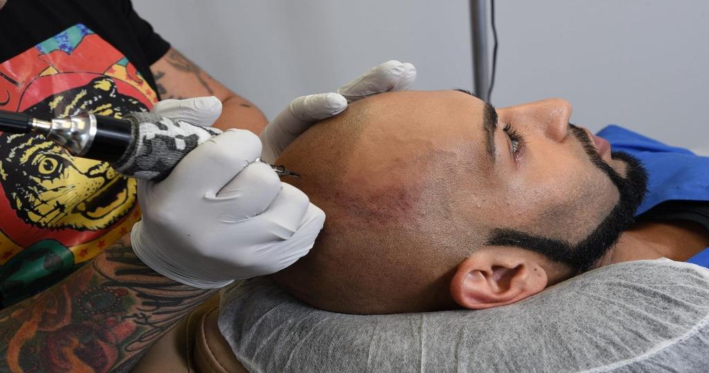 SCALP MICROPIGMENTATION KEY LEARNING POINTS Anatomy and physiology of the scalp Alternatives to scalp tattooing Understanding your patient Scalp tattooing for alopecia and pattern