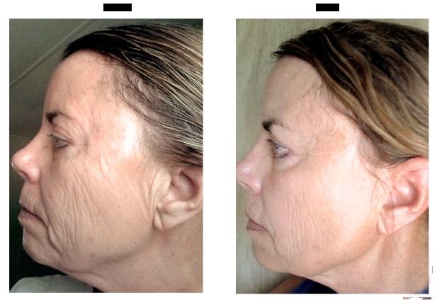 Promo #1 The "Perfect" Package- 1 Perfect Derma Peel & 1 Photo Rejuvenation (IPL) 30 days to amazing skin!