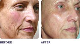 Promo #2 Photo Rejuvenation (IPL) As the baby boomer generation continues to age, the popularity of aesthetic procedures that aim to turn back the clock continues to skyrocket.