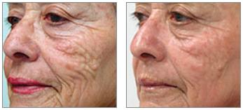Promo #3 For aged skin, laser skin resurfacing treatments can remove years of damage in as little as one quick treatment.
