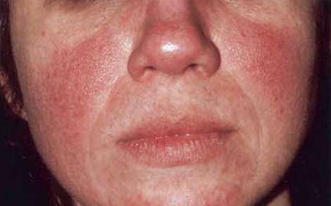 Rosacea What is Rosacea? Rosacea is a common but poorly understood long-term skin condition that mainly affects the face.