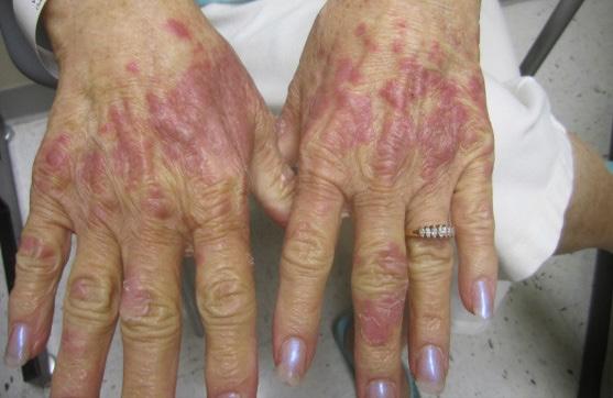 You may get a rash from the treatment itself or it may make you more sensitive to products you have used before.