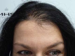 SMP FOR FEMALES Female pattern baldness (FPB) affects many more females than is generally known out there.