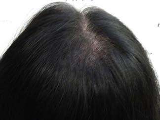 Hair Restoration Surgery in females is further complicated by a high prevalence in the development of acute hair shock loss and shedding postoperatively.