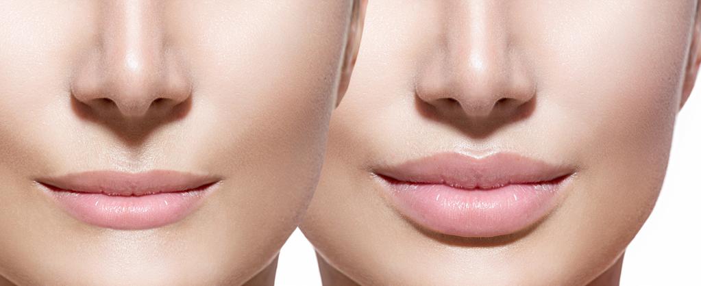 Dermal fillers Choose a non-surgical enhancement for your lips. Smooth smokers lines and marionette lines. Look younger, fresher and healthier.