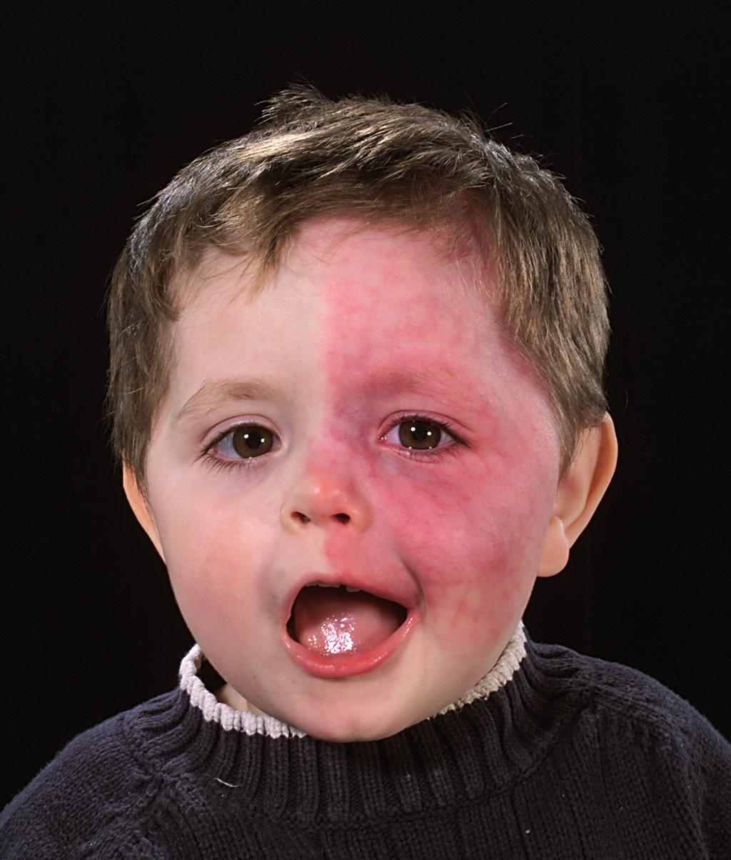2 Looking after your child s port wine stain Generally, port wine stains do not need any special treatment. However, they do need protection from the sun, before, during and after laser treatment.