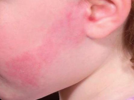 Port wine stains, particularly if they are on the face, can affect children psychologically, emotionally and socially.