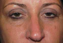 ADAM J. SCHEINER, M.D. Upper Eyelid Surgery There are two conditions that are the most common reason for requiring upper eyelid surgery.