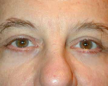 The Ultimate Guide to Eyelid Surgery FIG C.