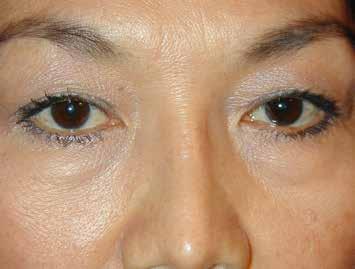 Special care is required when performing eyelid surgery for Asian
