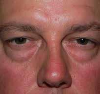 occurs occasionally. It involves a lack of fat in the lower eyelid region, called convexity.
