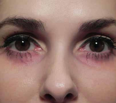 This patient with dark circles had fullness catching shadows, but she also had thin skin showing the pink vessels in this