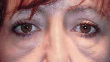 ADAM J. SCHEINER, M.D. The fifth cause of dark circles is the presence of lower eyelid and cheek swelling.