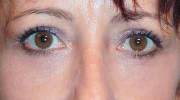 Festoons and malar mounds are often the most challenging of the 5 causes of dark circles to correct.
