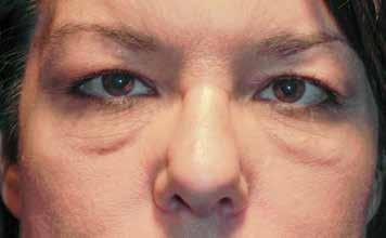 The Ultimate Guide to Eyelid Surgery YOU LOOK TIRED. ARE YOU OKAY? One of the most common changes that occur as we age is that we develop fullness in both the upper and lower eyelids.