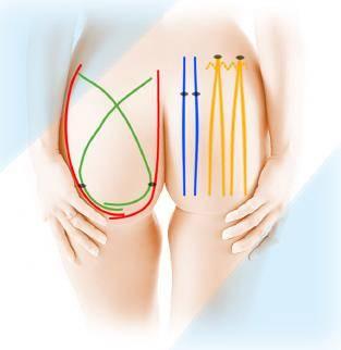 BUTTOCKS According to the patient morphology Passage of 4 threads BL 8-300 in L and J on each side of each buttock You can : Cross on to focus on the