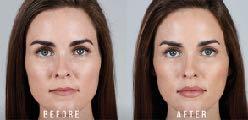 We use fillers that have incorporated anaesthetic into the injectable fillers to increase patient discomfort.