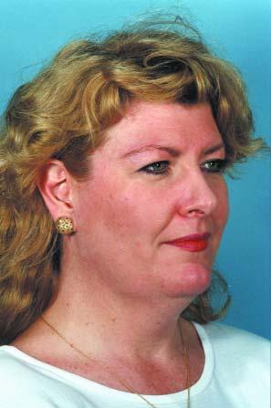Figure 12.2(a, b). Pre- and postop photographs of a woman who has undergone facial rejuvenation.