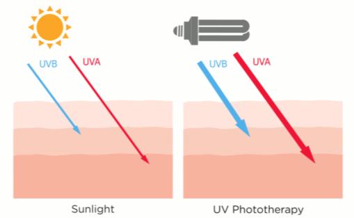 6 Basic Information on UV Phototherapy UV phototherapy is an established procedure, recognized for decades for the treatment of various skin diseases, particularly psoriasis, neurodermatitis and