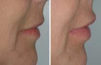 Figure 11 A patient before and after use of Advanta lip implants. Notice the increase in volume, pout, and projection in the afterpicture. This product will enhance cosmetic dental procedures.