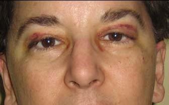 When pinched, the fluid fluctuates, but and the contour of the fluid does not change while looking upward or downward. Figure 7 a. Pre-operative Patient with eyelid fluid; b.
