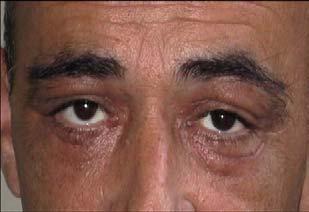 Посt-оpераtивно Material and Methods During a six year period, 2000 2005, lower eyelid Blepharoplasty was carried out in 42
