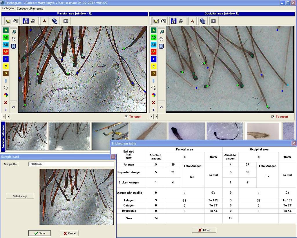 The Trichogram study is a semi-invasive method used to evaluate the roots of extracted hairs.