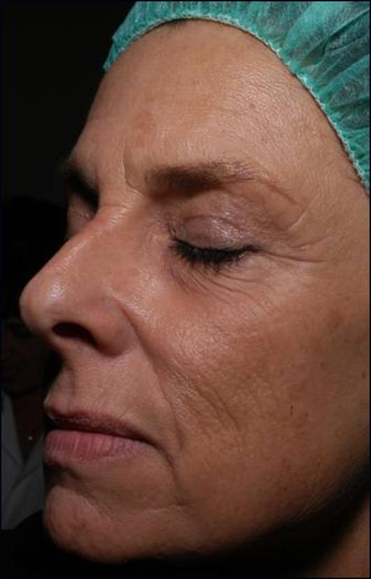Patient Quote: My skin texture has improved greatly and my sun damage is gone.