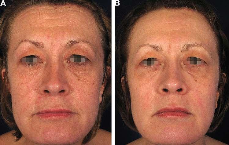 *0 ¼ not satisfied at all, 1 ¼ dissatisfied, 2 ¼ not too satisfied, 3 ¼ partly dissatisfied and partly satisfied, 4 ¼ rather satisfied, 5 ¼ satisfied, 6 ¼ very satisfied. Fig. 3. A 51-year old Caucasian woman before (a) and three months after (b) fractional skin resurfacing.